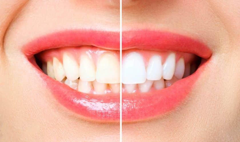 The Role Of Dentists In Teeth Whitening: What You Need To Know