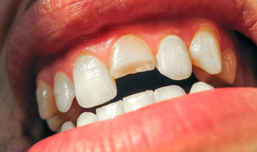 Can A Tooth Crack In Half And Be Fixed?