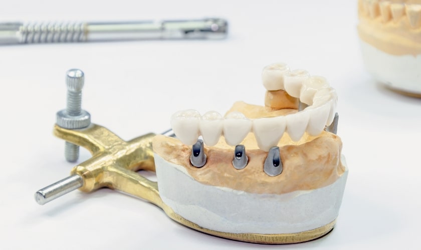 How High Are Dental Implant Success Rates? Ask Your Restorative Dentist